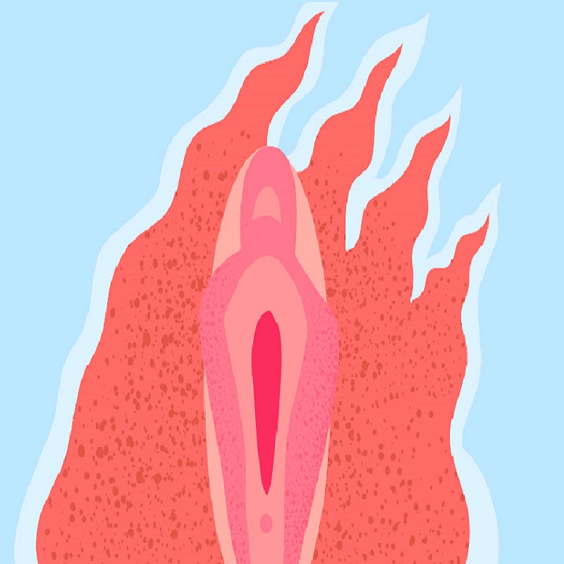 Vaginal dryness is extremely common during menopause. It’s just one of a collection of symptoms known as the genitourinary syndrome of menopause (GSM) that involves changes to the vulvovaginal area, as well as to the urethra and bladder. These changes can lead to vaginal dryness, pain with intercourse, urinary urgency, and sometimes more frequent bladder infections. These body changes and symptoms are commonly associated with decreased estrogen. However, decreased estrogen is not the only cause of vaginal dryness. It is important to stop using soap and powder on the vulva, stop using fabric softeners and anticling products on your underwear, and avoid wearing panty liners and pads. Vaginal moisturizers and lubricants may help. Persistent vaginal dryness and painful intercourse should be evaluated by your healthcare provider. If it is determined to be a symptom of menopause, vaginal dryness can be treated with low-dose vaginal estrogen, or the oral selective estrogen-receptor modulator ospemifene can be used. Regular sexual activity can help preserve vaginal function by increasing blood flow to the genital region and helping maintain the size of the vagina. Without sexual activity and estrogen, the vagina can become smaller as well as dryer.